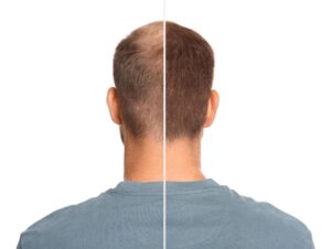 benefits of Hair Transplant