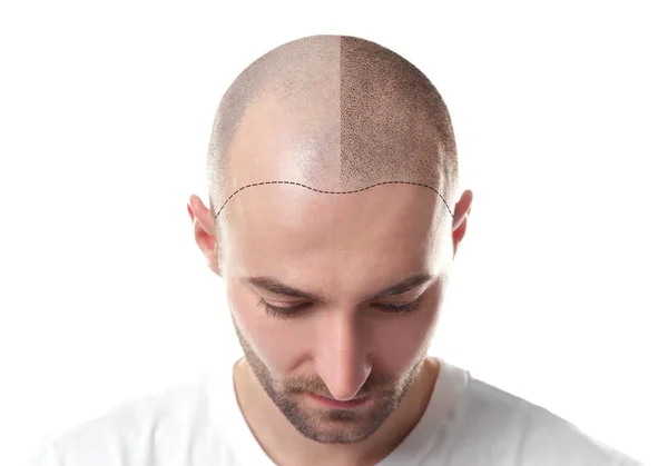 Scalp Micropigmentation in Mumbai