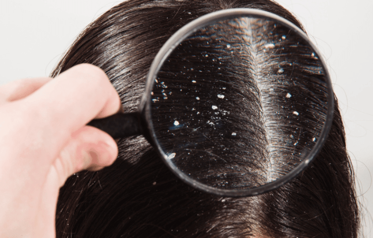 Dandruff-Free Treatment: Your Effective Dandruff Treatment Solution