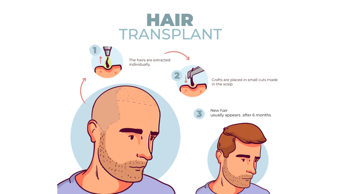 Everything You Need to Know About Hair Transplants