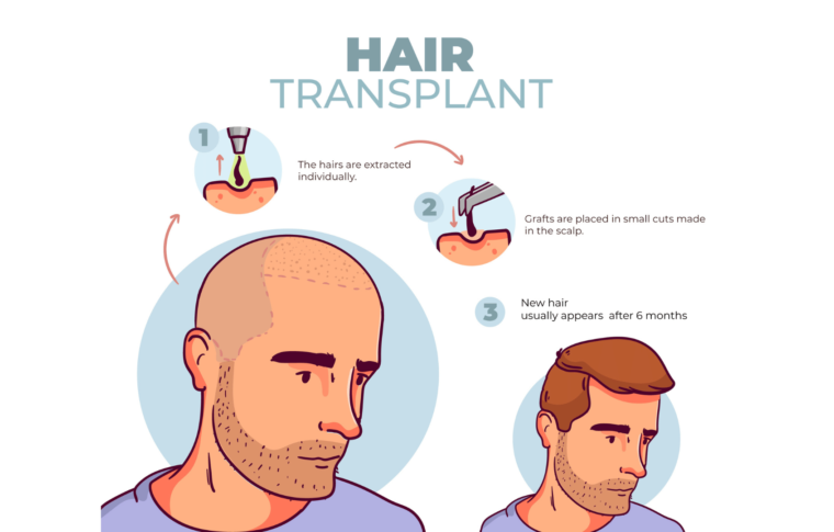 Everything You Need to Know About Hair Transplants