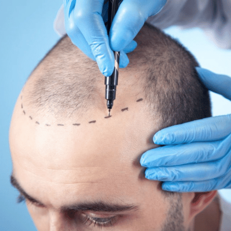 Scalp Micro-pigmentation