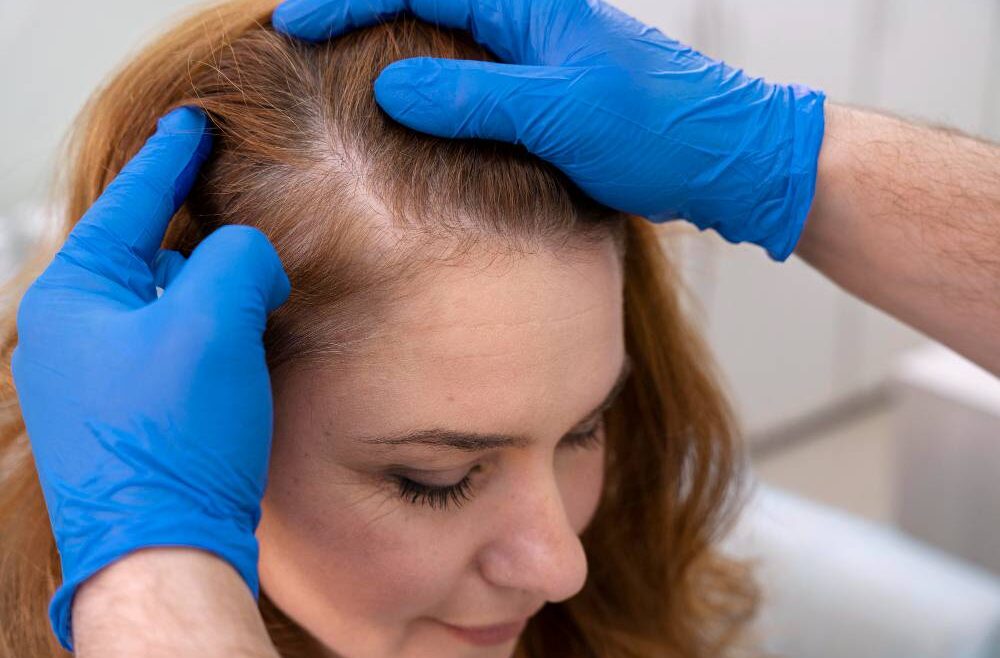 A Comprehensive Guide to Non-Surgical Hair Replacement