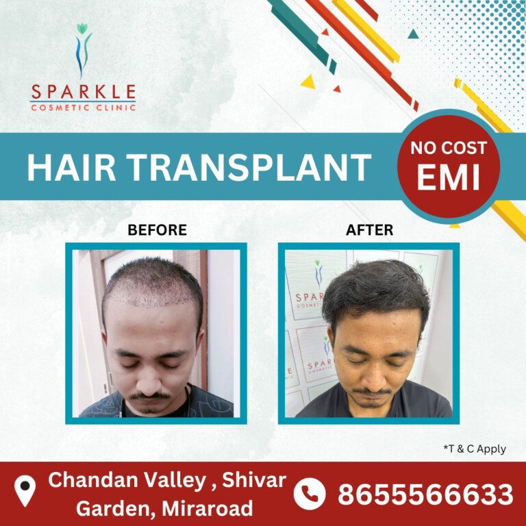 Best hair transplant clinic in Mumbai