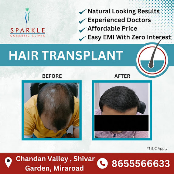 Best hair transplant clinic in Mira Bhayandar