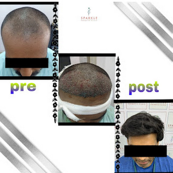 Hair Transplant in Mumbai - Before and After