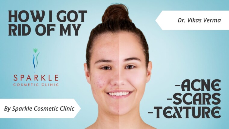 How to Treat Body Acne – A Comprehensive Guide