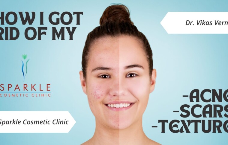 How to Treat Body Acne – A Comprehensive Guide