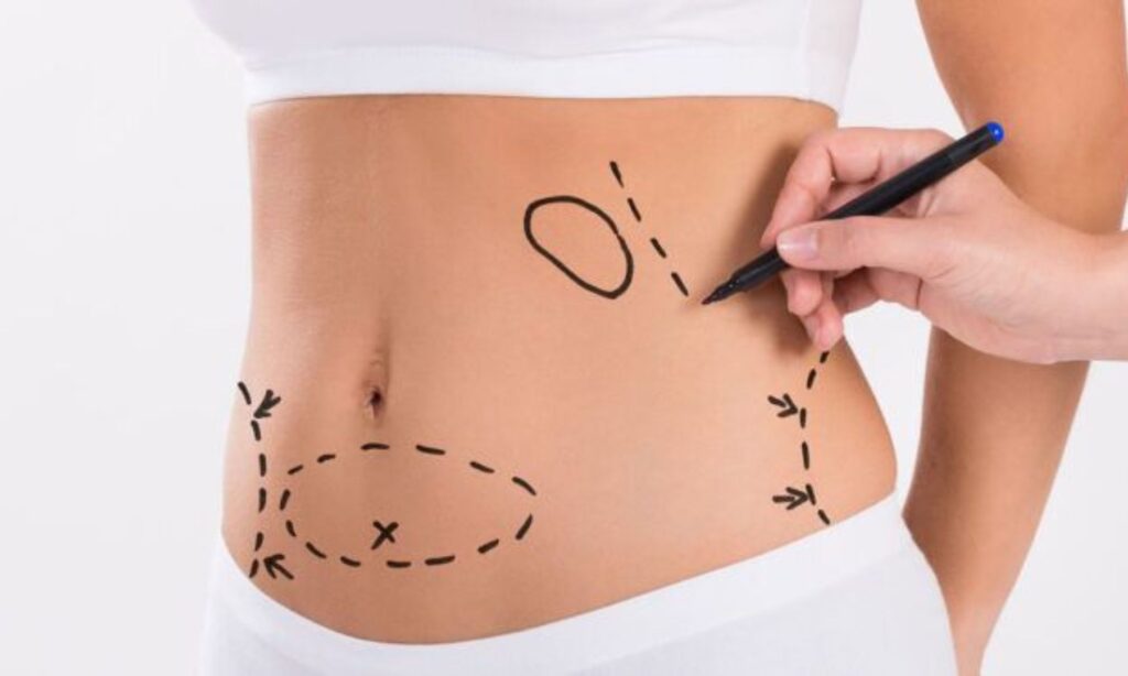 Liposuction in Mumbai