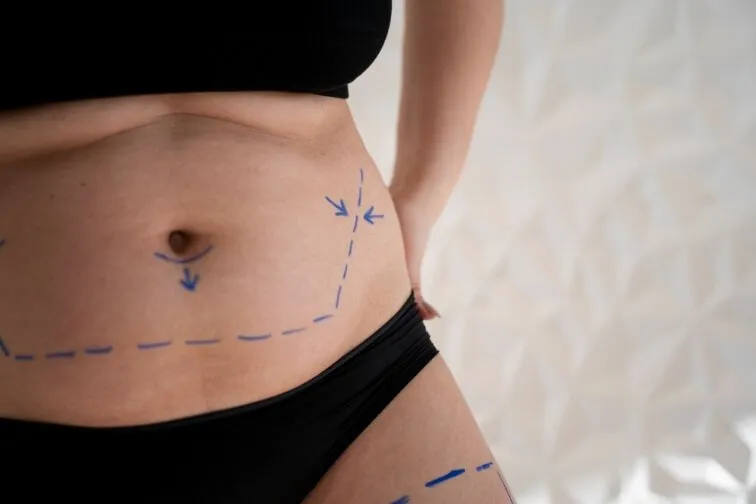 Liposuction in Mumbai