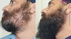 Beard Transplant
