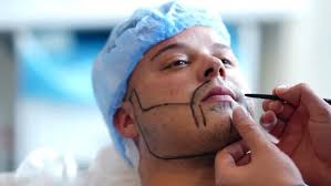 Moustache Transplant​