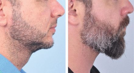 Facial Hair Density Treatment​