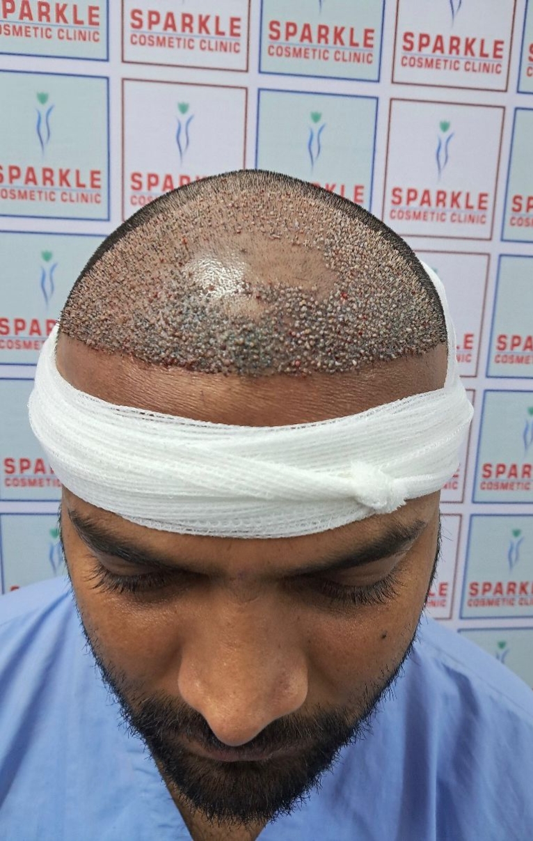 Scalp Micropigmentation​