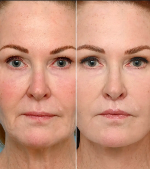 Skin Tightening Treatment