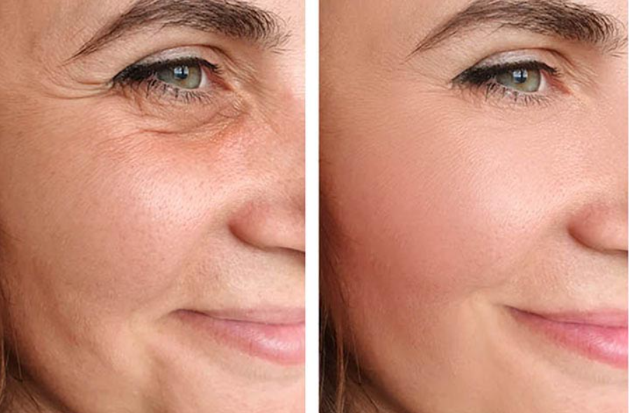 Face Lifting Therapy​