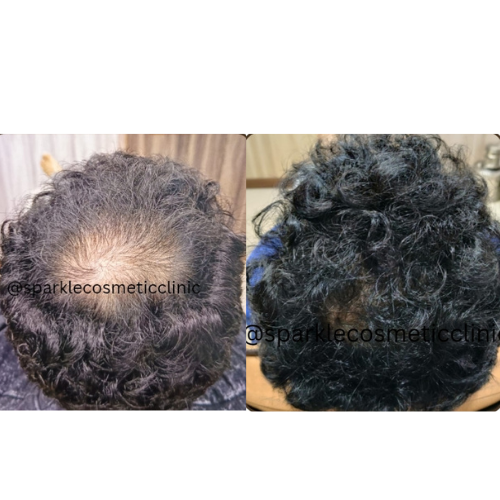 GFC Hair Treatment​
