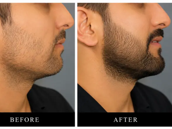 Beard & Moustache Transplantsparkle cosmetic Hair Transplant clinic in miraroad, mumbai
