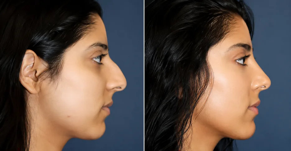 Best Rhinoplasty Treatment expert in mira road Mumbai.
