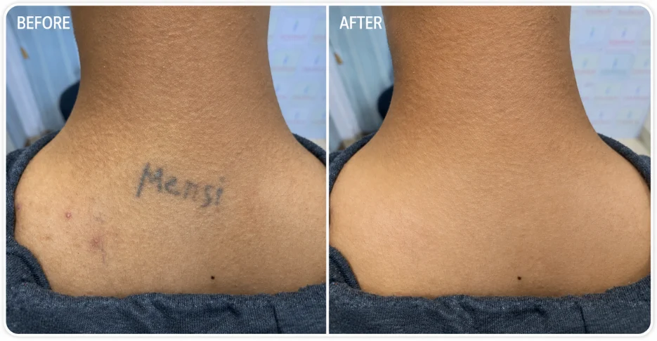 Best Tattoo Removal expert in mira road Mumbai.