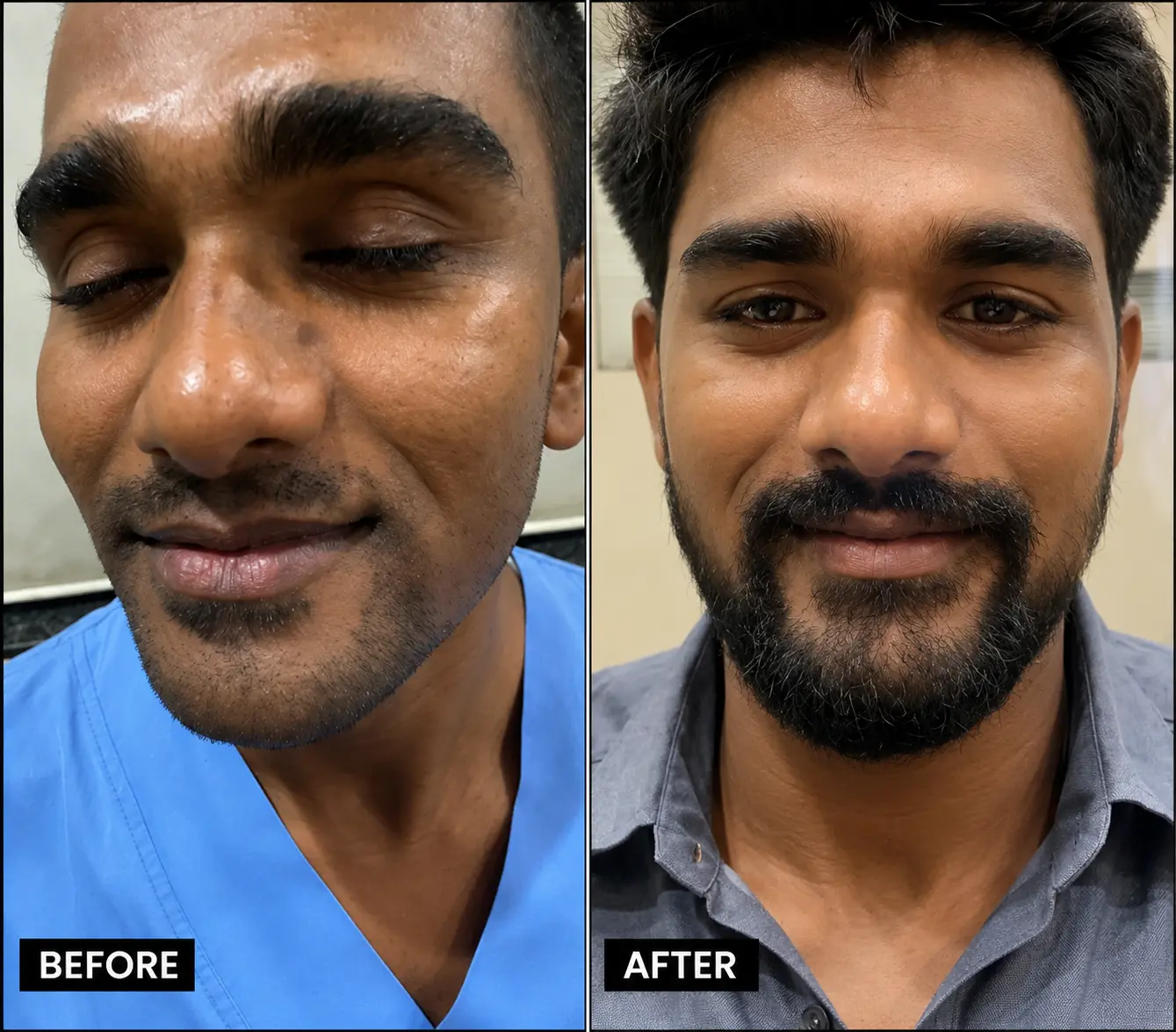 Facial Hair Treatment in miraroad mumbai