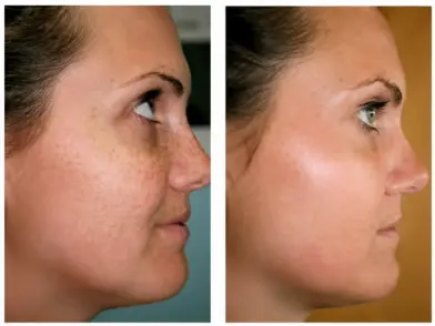 Cosmetic Treatment- Skin Brightening Peel in mira road mumbai