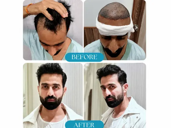 Hair Regrowth Solution - sparkle cosmetic Hair Transplant clinic in miraroad, mumbai