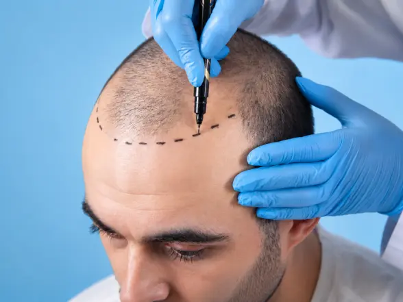 Hairline Design- sparkle cosmetic Hair Transplant clinic in miraroad, mumbai