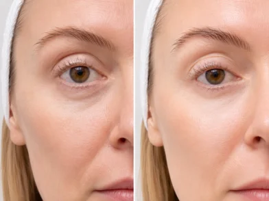 Laser treatment- CO2 Laser Treatment mira road mumbai
