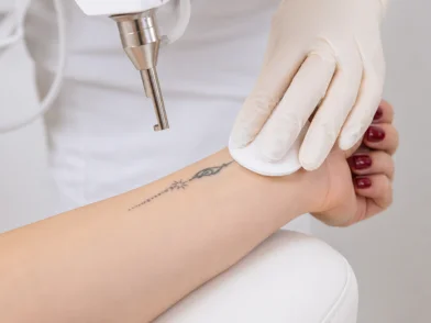 Laser treatment- Laser Tattoo Removal in mira road mumbai