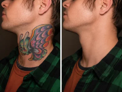 Laser treatment- Multi-Color Tattoo Removal in mira road mumbai