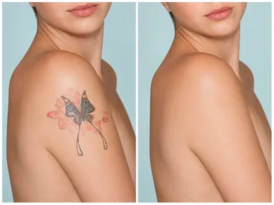 Laser treatment- Permanent Tattoo Removal in mira road mumbai
