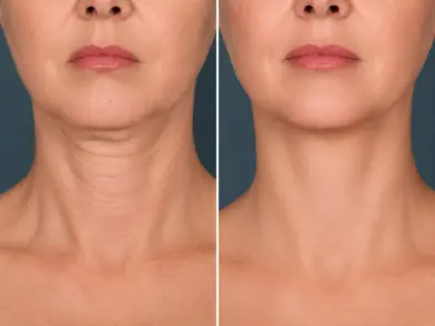 Laser treatment - Skin Tightening Treatment in mira road mumbai