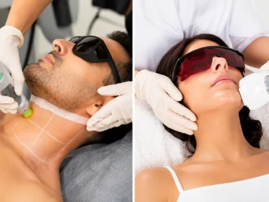 Laser treatment - laser Hair Removal in mira road mumbai