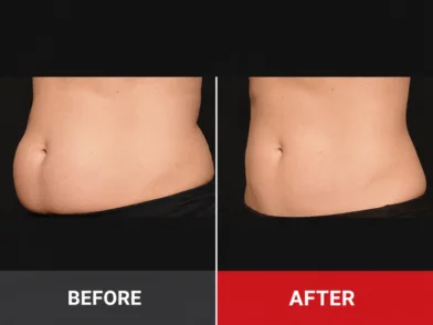 Plastic Surgery- Advanced Fat Sculpting in mira road mumbai