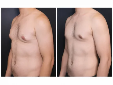 Plastic Surgery- Chest Contouring Procedure in mira road mumbai