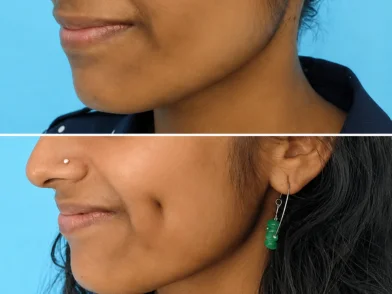 Plastic Surgery- Dimple Creation Surgery in mira road mumbai