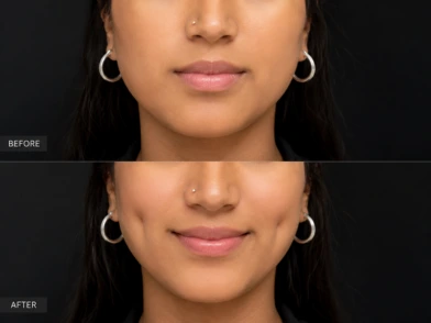 Plastic Surgery- Facial Aesthetic Improvement in mira road mumbai