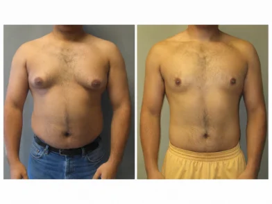Plastic Surgery- Male Chest Fat Reduction in mira road mumbai