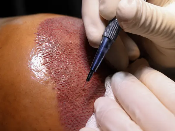 Sapphire Hair Transplant - sparkle cosmetic Hair Transplant clinic in miraroad, mumbai