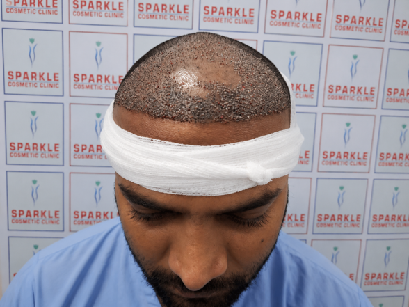 Scalp Micropigmentation - sparkle cosmetic Hair Transplant clinic in miraroad, mumbai