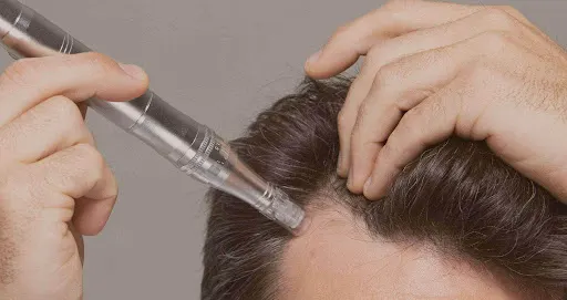 Scalp Micropigmentation - sparkle cosmetic Hair Transplant clinic in miraroad, mumbai