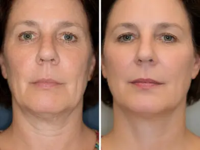 cosmetic Treatment-Anti-Ageing Solution in mira road mumbai