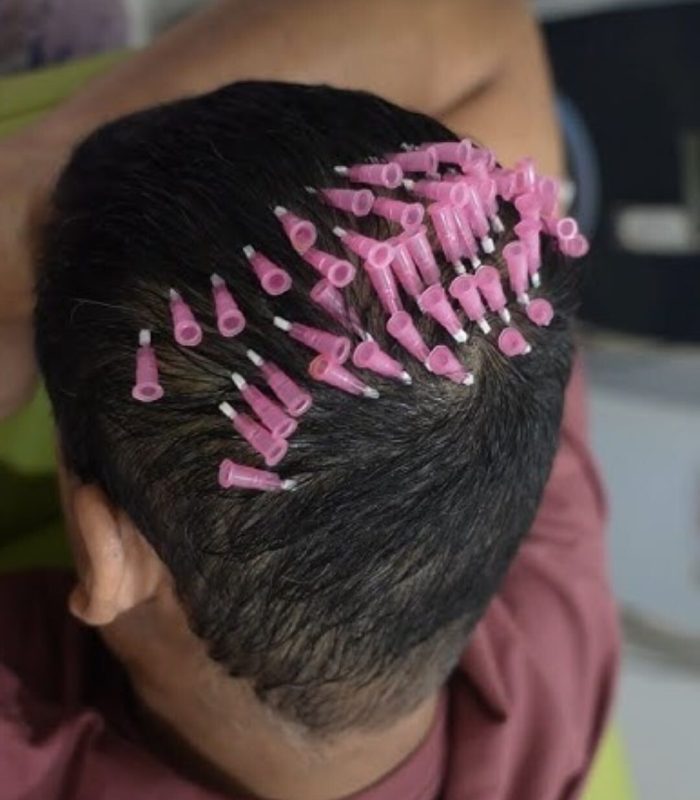 Hair Threads Treatment in Mumbai