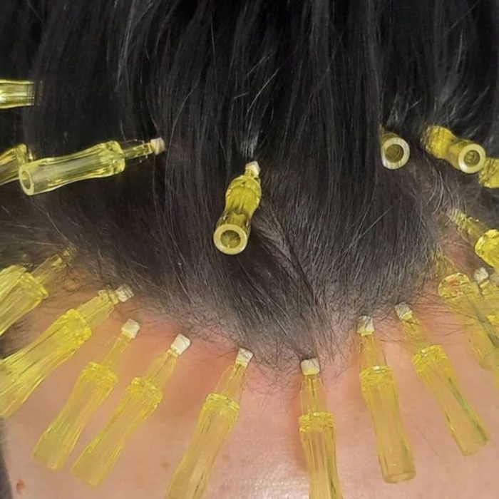 Hair Threads Treatment in Mumbai