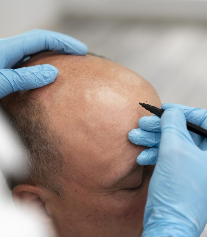 Sapphire Hair Transplant in Mumbai